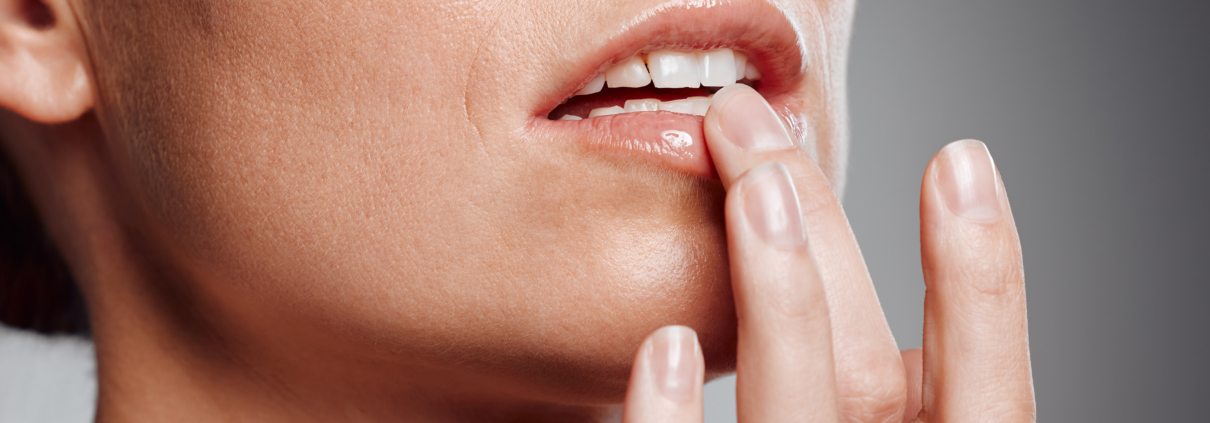 cold sore prevention