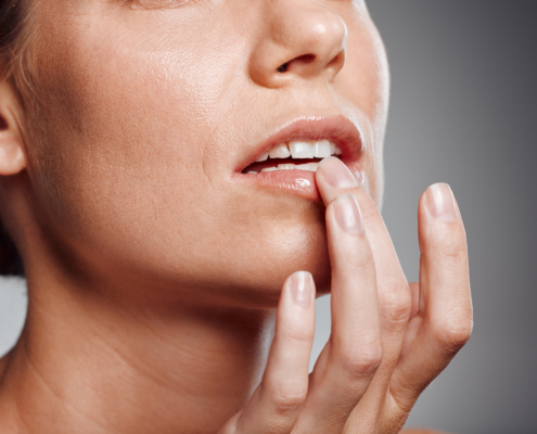 cold sore prevention