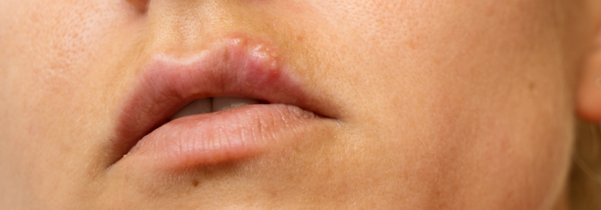 Cold Sore Prevention