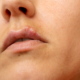 Cold Sore Prevention