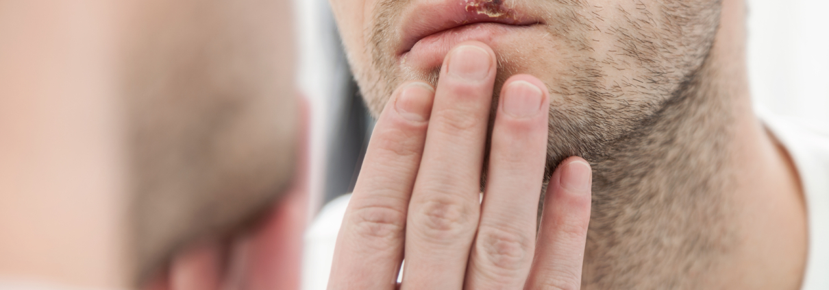 Abreva can not prevent a cold sore outbreak