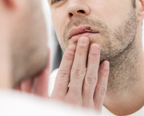 Abreva can not prevent a cold sore outbreak